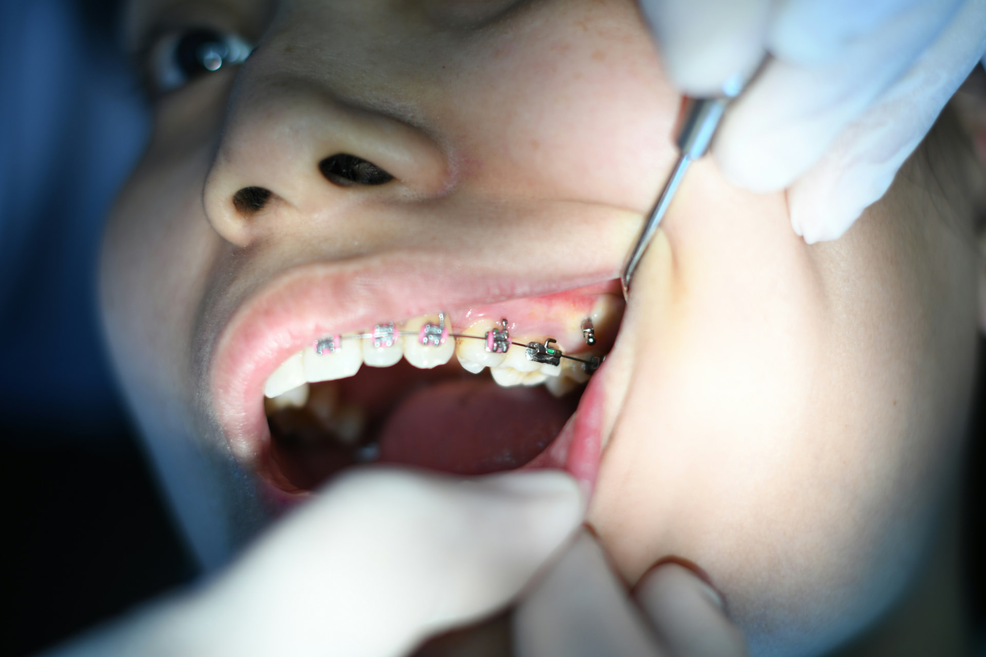Tooth Extraction at Aroma Dental in Humble, TX: a dentist reassuring a patient before a gentle tooth extraction
