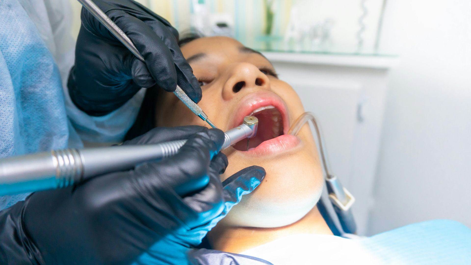 Tooth Filling at Aroma Dental in Humble, TX: a dentist placing a shade matched composite tooth filling in a prepared cavity