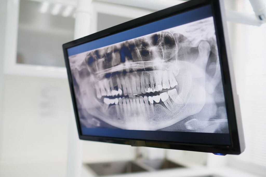Close-up of a dental X-ray displayed on a monitor in a dental clinic setting, emphasizing dental care technology.