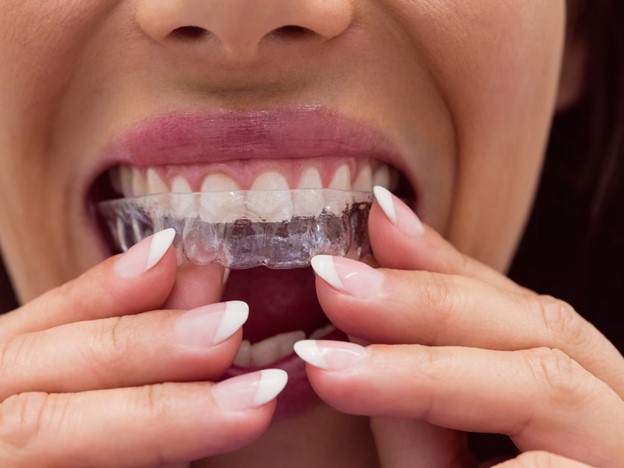 Braces and clear aligners