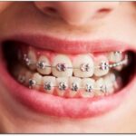 The Different Types of Teeth Braces Available in Humble