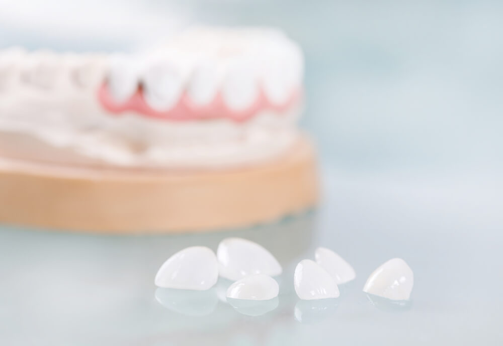 PORCELAIN VENEERS VS DENTAL CROWNS