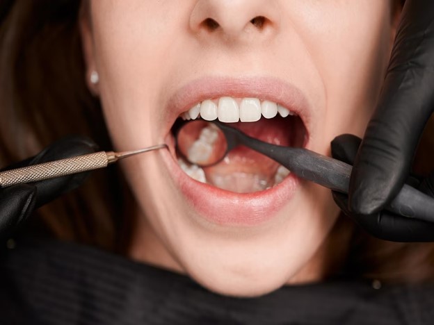 Treatment Options for a Chipped or Broken Tooth