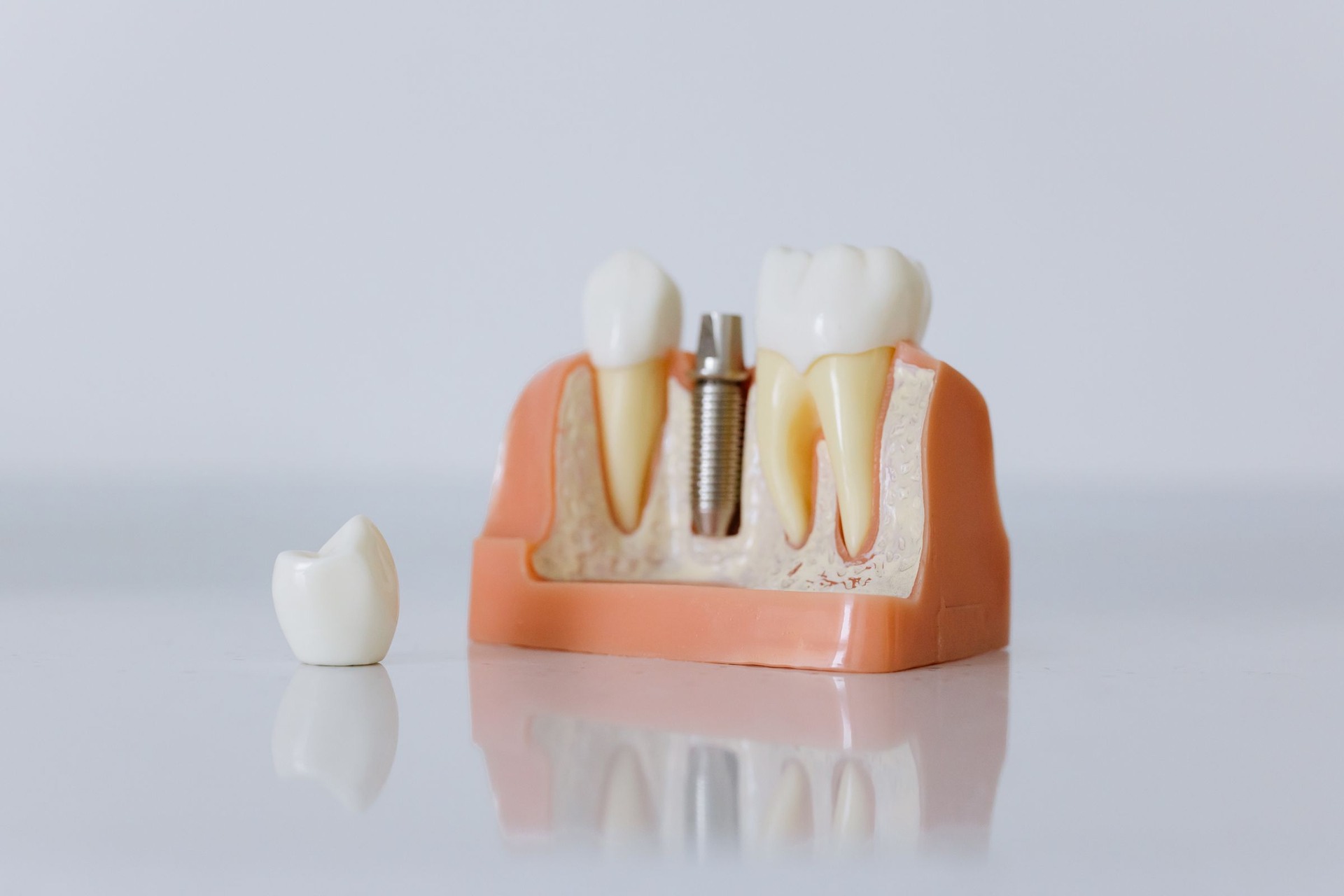 Dental implant model